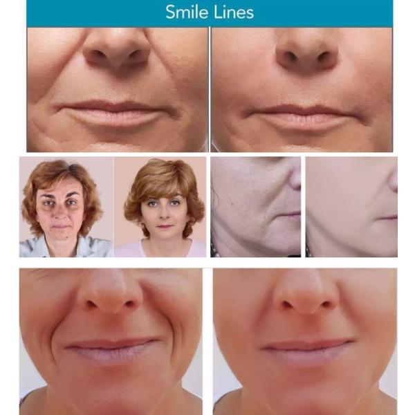 Facial Filling Cross Linked Dermal Filler Lip Filler Injections