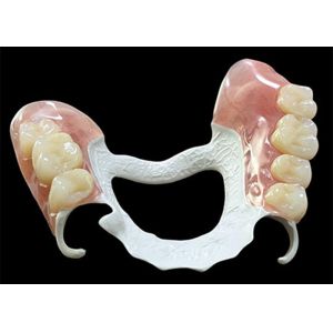 Customized Partial Removable Denture with High-Performance Polymer (HPP)