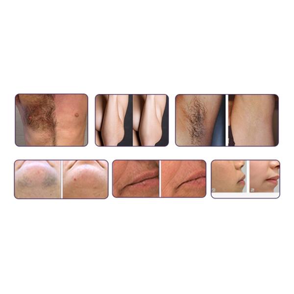 1064nm Diode Laser Hair Removal Machine Permanent Pain Free For Salon