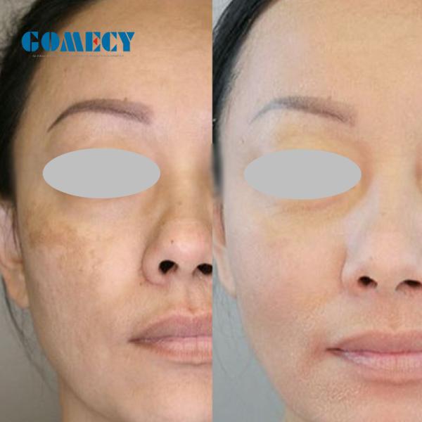 2000W Q Switched Nd Yag Laser Tattoo Removal Machine 50kg With LCD Touch Screen