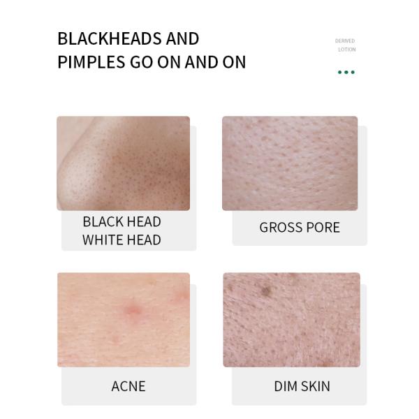 Soften Lackhead Derived Essence Face Serum Blackhead Remover Serum