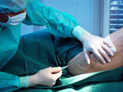 Power assisted liposuction BS-LIPS3