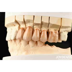 Bionic Development Leaves And Distinct Layers Of Zirconia All-Ceramic