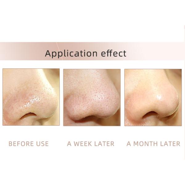 Pore Cleaner Black Head Suction Extractor Tool Kit Acne Removal Blackhead Remover Vacuum