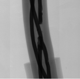 High Precision Inline X Ray Inspection for Electronic Components Defect Detection