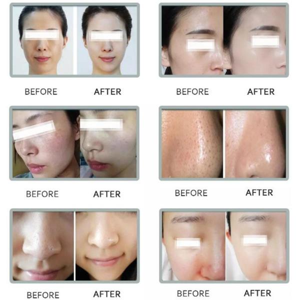 Multi Function 8 Handles Hydro Oxygen Facial Machine Elight Probes