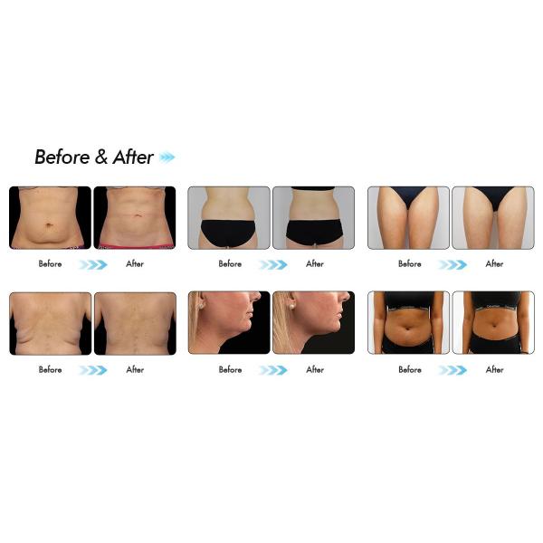 2 Handles Cryolipolysis 360 Machine Fat Removal Body Slimming Machine