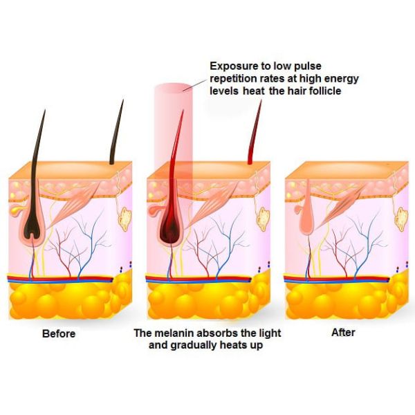Protable Diode Laser Hair Removal Machine