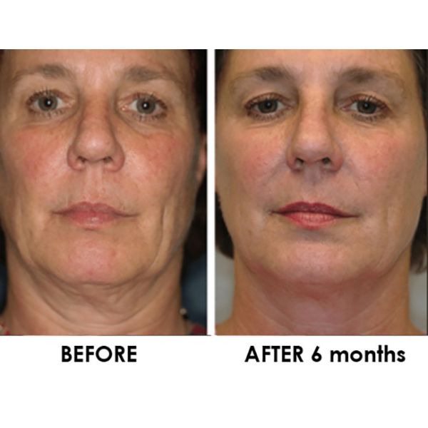 5D Ice 5 Cartridges Radio Frequency Portable HIFU mahcine