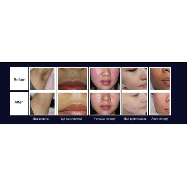 E Light Shr Rf Nd Yag Laser Beauty Machine 3 In 1 for Hair Removal