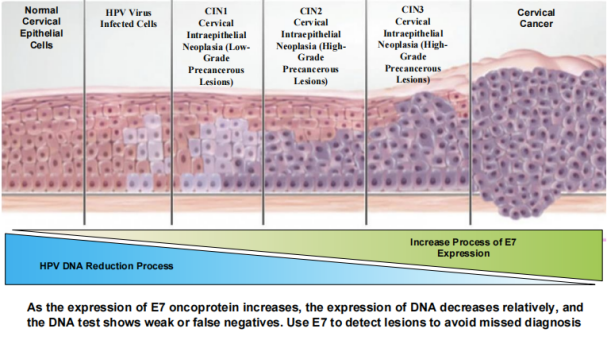HPV E7 Oncoprotein Test Kit for Cervical Cancer Screening with 15 min Results, Self-Sampling, and Direct Cancer Cell Protein Detection