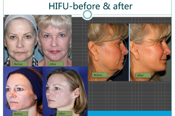 2015 new product CE approved hifu machine