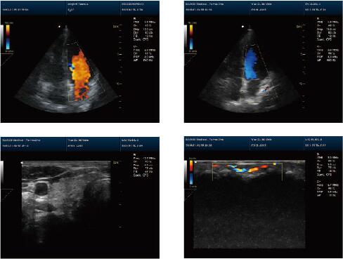15”LED Portable Color Doppler Machine Digital Color Ultrasonic Diagnostic System