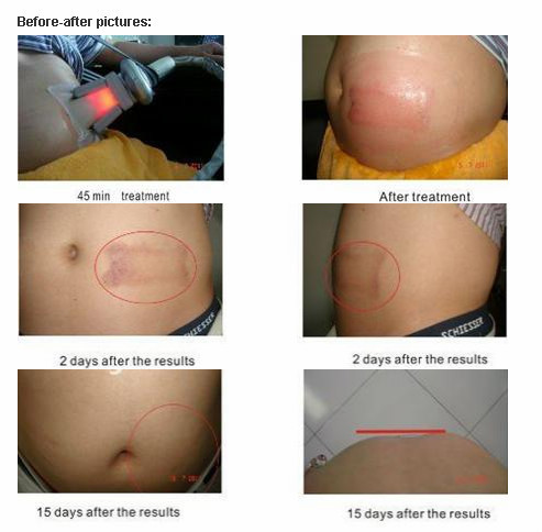 Cryolipolysis Machine, Cryolipolysis Fat Freezing Machine, Cryolipolysis Slimming Machine