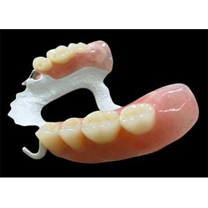 Customized Partial Removable Denture with High-Performance Polymer (HPP)