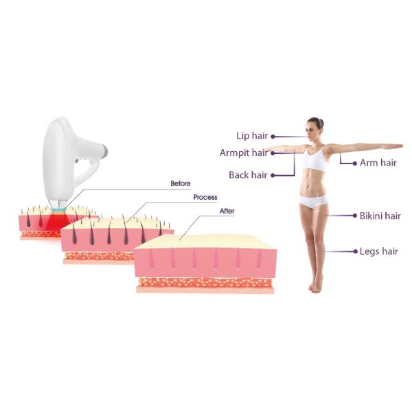 1064nm Diode Laser Hair Removal Machine Permanent Pain Free For Salon