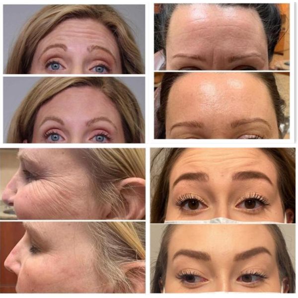 ISO Wrinkle Removal Allergan 100 Units For Face Lift Injection